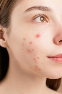 A woman with face acne scars