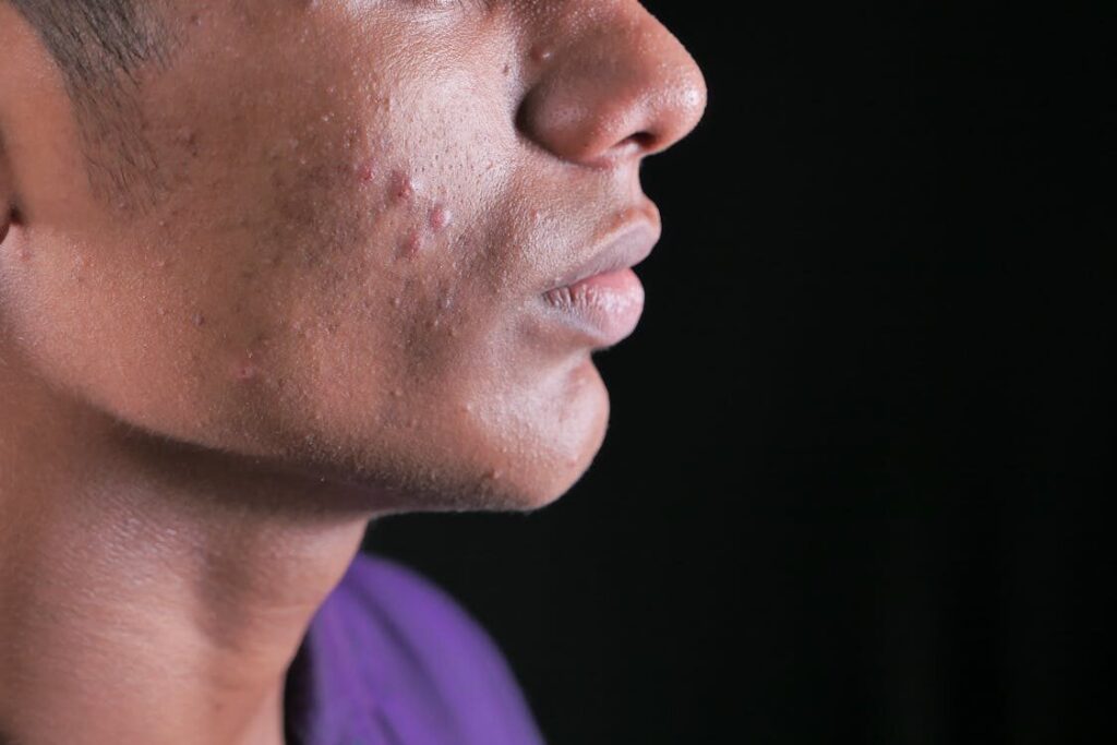 Closeup of a Man’s Acne-riddled Cheek