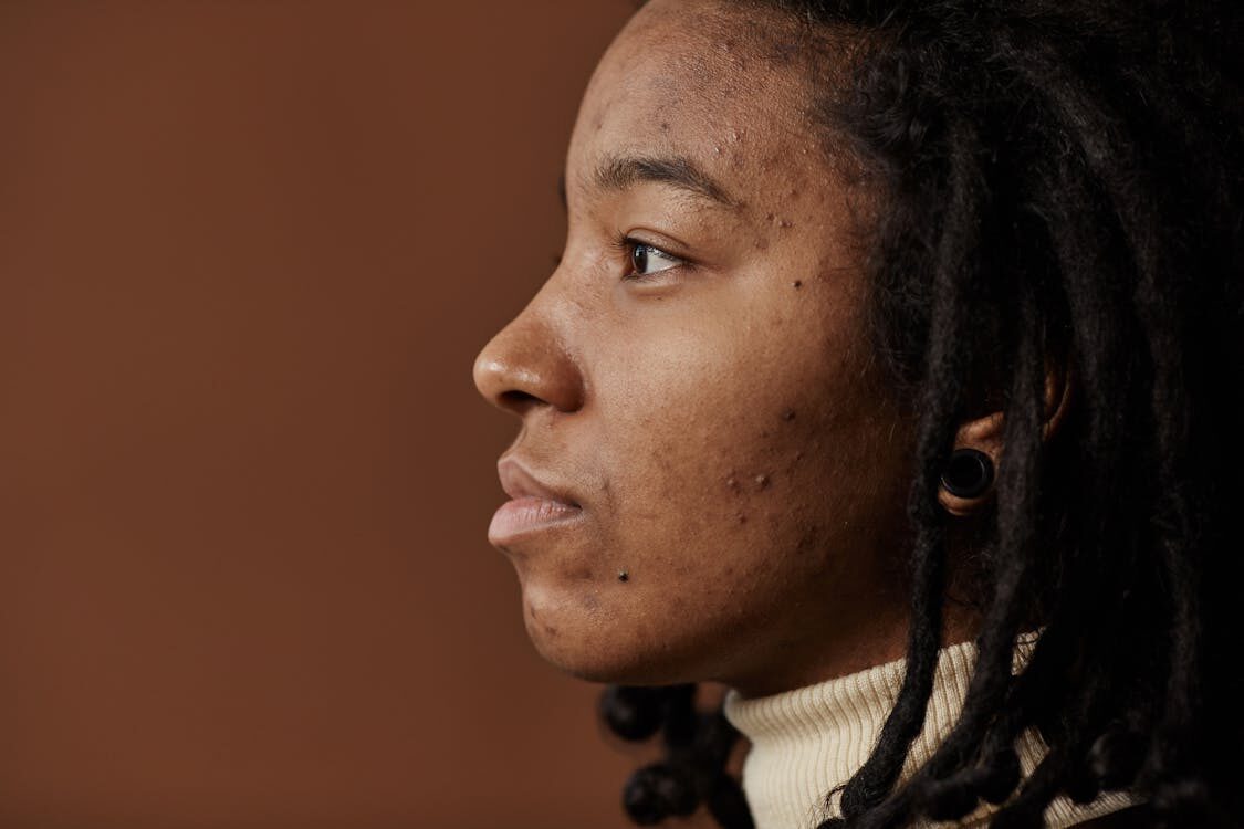 Profile View of a Woman’s Face Needing Skincare Ingredients to Fight Acne