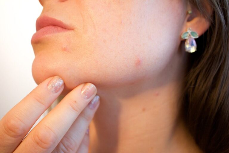 A woman checking her acne